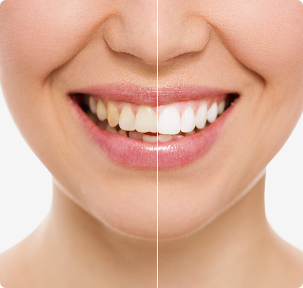 Split image of a smiling person’s lower face, with the left side showing yellowed teeth and the right side showing whitened teeth